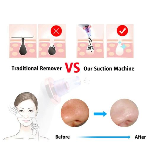 Blackhead Removal Suction Tool - BeautyHacks